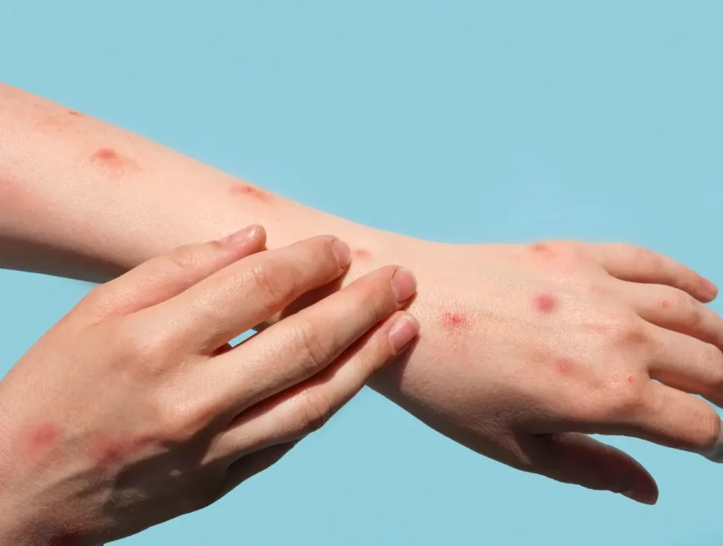 أول تحرك من وزارة الصحة بعد إعلان جدري القردة "حالة طوارئ صحية عامة